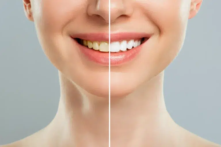 Blog 5 Benefícios do clareamento dental: descubra como transformar seu sorriso